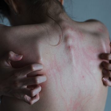 Adolescenza. Il corpo sotto attacco